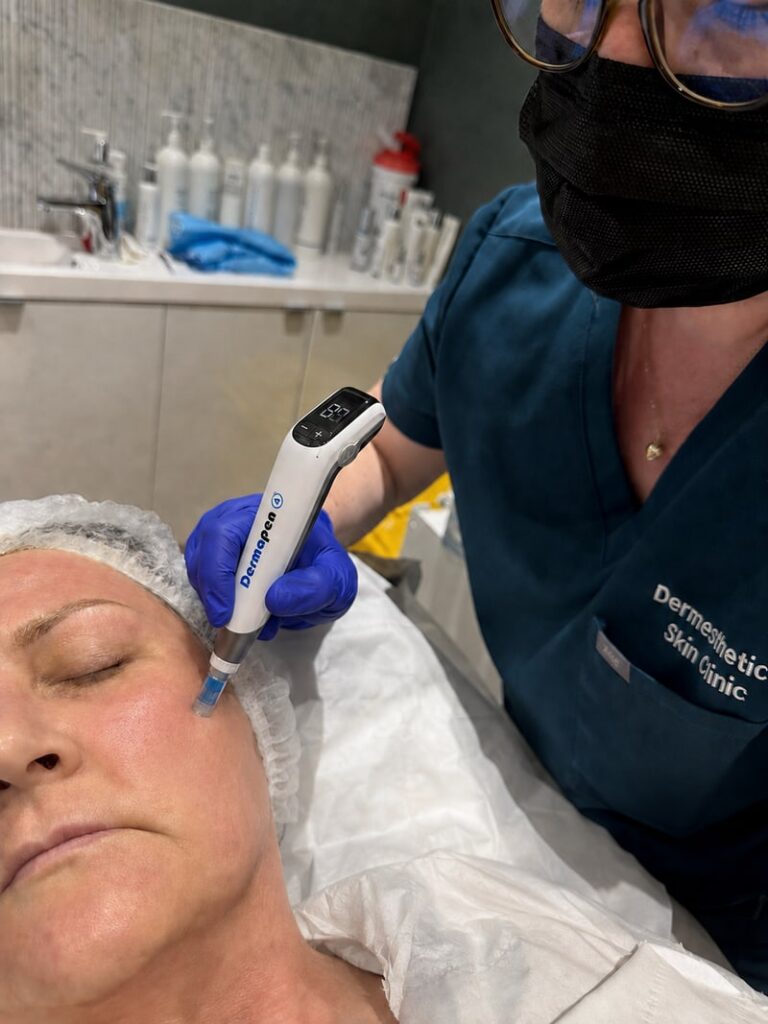Dermapen 4 microneedling treatment being performed at Dermesthetica Skin Clinic